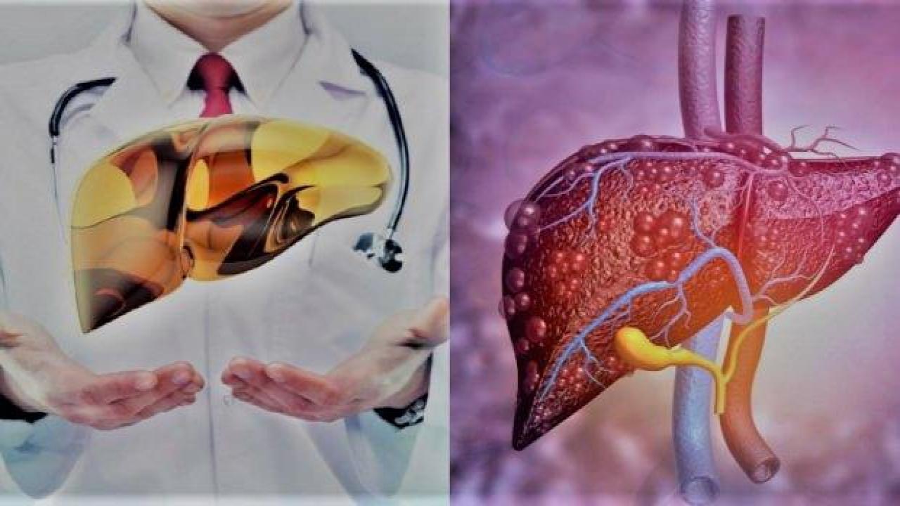 Karaciğer yağlanmasını ne temizler: Karaciğer yağlanmasına iyi gelen tedavi yöntemleri