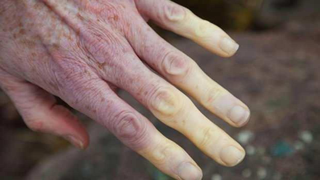 Lupus hastalığı nedir, belirtileri nelerdir? Tedavisi var mıdır?