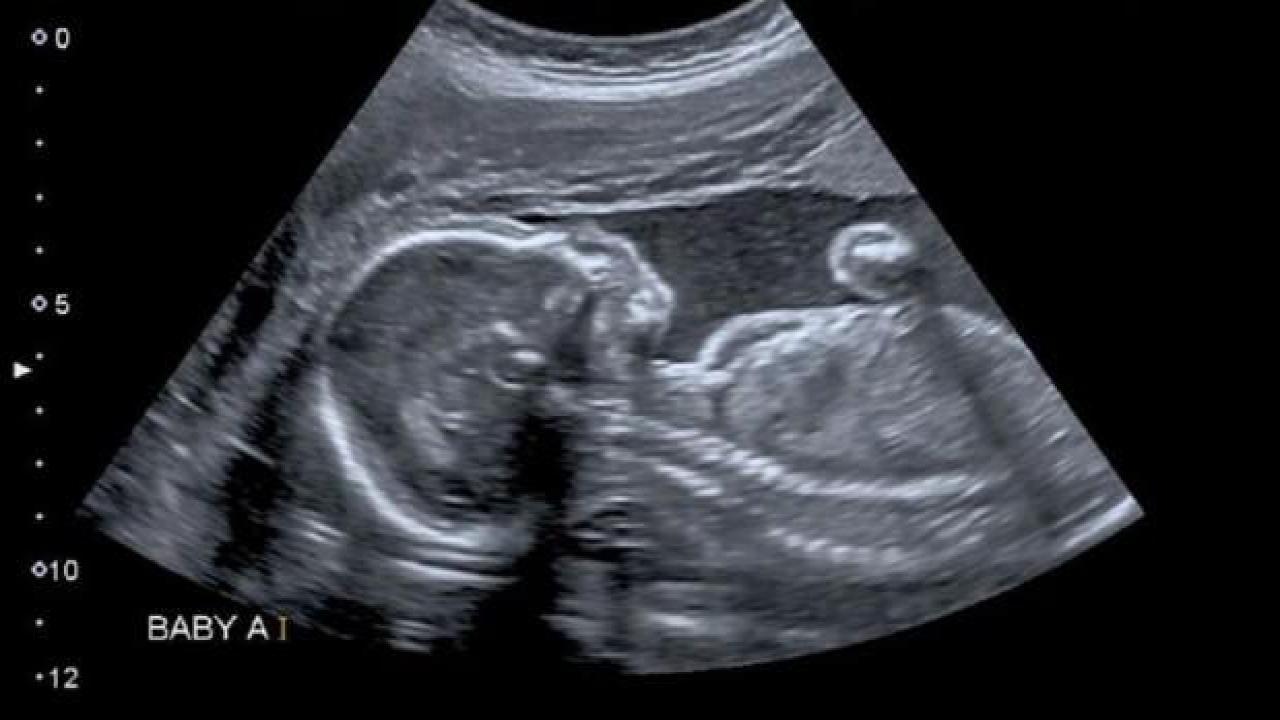 ABD tıp tarihine geçti: Anne karnındaki bebeğe beyin ameliyatı