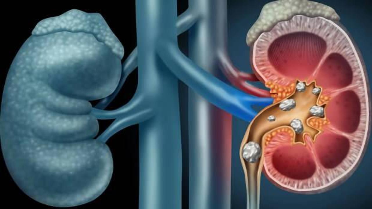 Uzmanlar uyardı: Bu besinler böbrek taşı oluşumunu destekliyor!