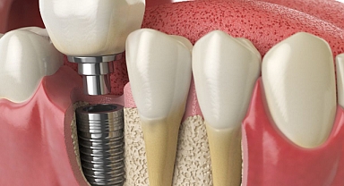Diş Tedavisinde Yeni Dönem: İmplant SSK Kapsamına Giriyor