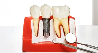 İmplant Tedavisinin SSK Kapsamına Alınması İçin TBMM'ye Kanun Teklifi Sunuldu