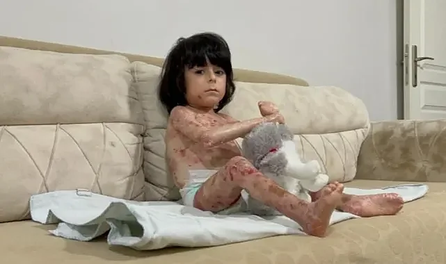 4 Yaşındaki İbrahim'in 'kelebek hastalığı' hayatını zorlaştırıyor