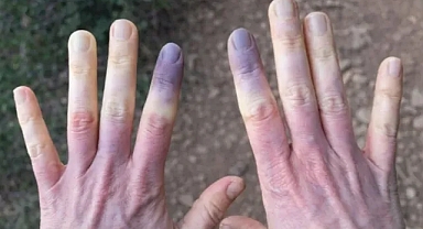  Ciltte Maviye Dönük Soluk Renge Dikkat